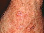 Is it skin cancer? - Is it skin cancer? - Pictures - CBS News