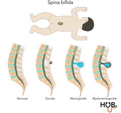 Spina Bifida — Geneeskundehub