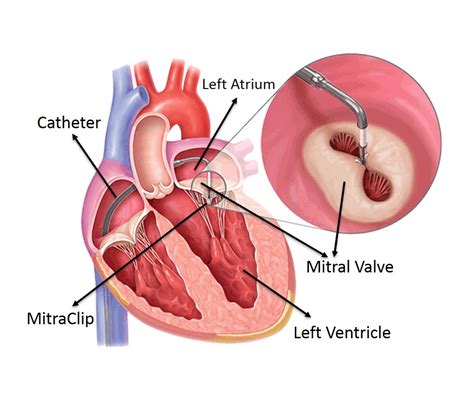 Heart Valve Repair Without Open Heart Surgery Performed At Fortis Escorts Heart Institute Newznew