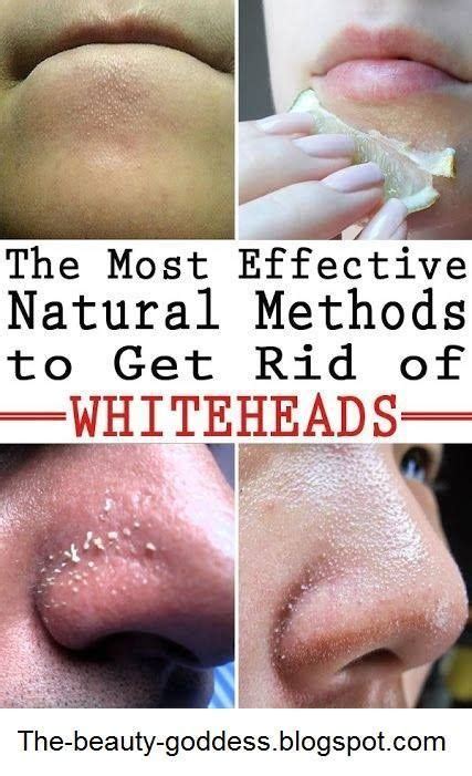 How To Get Rid Of Whiteheads Naturally Whiteheadsonforehead How To