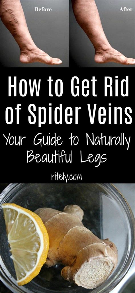 How To Get Rid Of Spider Veins Your Guide To Naturally Beautiful Legs