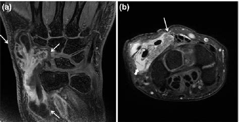 Figure 1 From Lipoma Arborescens In The Extensor Tendon Sheath Of The