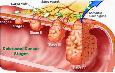 Colon Cancer And Colon Cancer Symptoms Colon Cancer Symptoms Riset