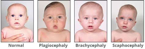 Baby Head Shape Assessment For Plagiocephaly Flat Head