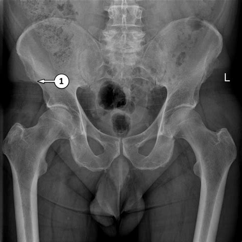 Pelvic Bone Anatomy X Ray