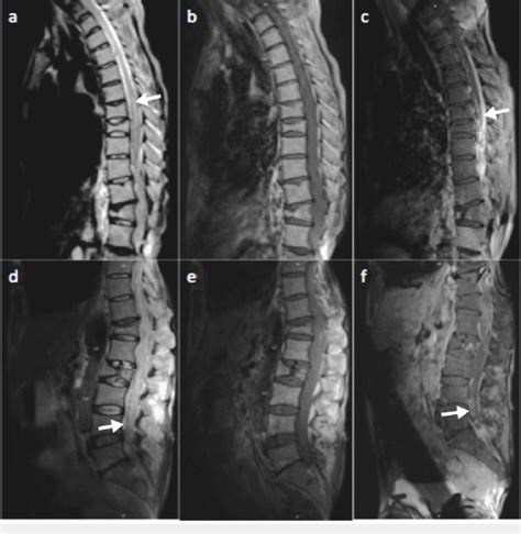 Mri Scan Of Thoracic Upper Row And Lumbar Spine Lower Row With And