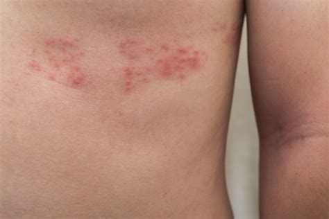 10 Alarming Shingles Signs And Symptoms With Pictures Healthvibe