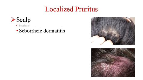 Localized Pruritus Scalp Psoriasis Localized Pruritus Scalp Psoriasis