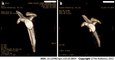 Arthroscopy With Subscapularis Upper One Third Tenodesis For Treatment