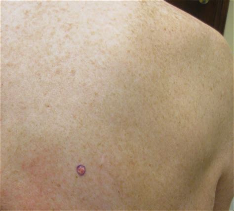 Complete Remission Of Metastatic Merkel Cell Carcinoma In A Patient