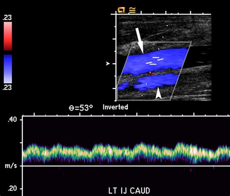 Upper Extremity Venous Doppler Ultrasound Radiologic Clinics