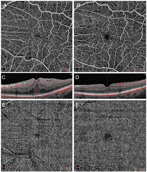 Diagnostics Free Full Text Microvascular Changes After Epiretinal