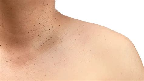 Remove Black Spots On Back And Neck