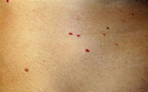 What Causes Red Spots On Skin And How To Treat Them Skinkraft