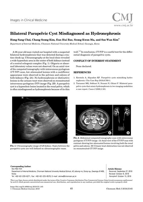 Pdf Bilateral Parapelvic Cyst Misdiagnosed As Hydronephrosis