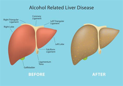 Before And After Alcohol Liver