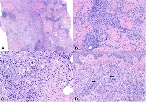 Xanthomatous Cutaneous Rosai Dorfman Disease With Overlapping Features