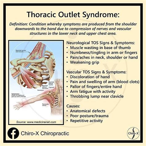 Thoracic Outlet Syndrome Can Be Detected On A Patient By Using Adsons