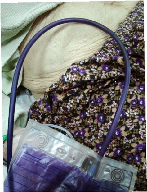 Purple urine bag syndrome most commonly occurs in chronically catheterized patients who develop urinary tract infections. Purple urine bag syndrome | Emergency Medicine Journal
