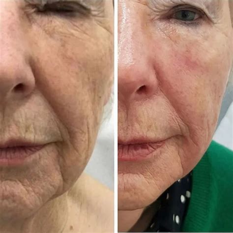 Facelift In 5 Renew Medical Aesthetics Cheshire Clinic