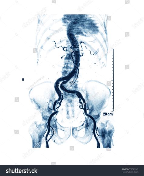 Computed Tomography Angiography Cta Abdominal Aorta Stock Photo