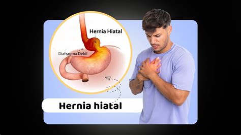 Cirugía De Hernia Hiatal Reflujo Acalasia Youtube