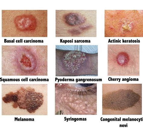 Types Of Skin Lesions Medical Addicts Terms Used To Describe Skin
