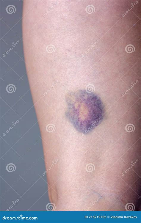 Large Round Bruise On The Leg Stock Photo Image Of Caucasian