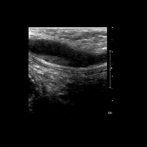 Ultrasound Upper Extremity Venous Anatomy