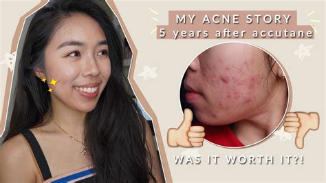 My Acne Story 5 Years After Accutane Did It Work Youtube