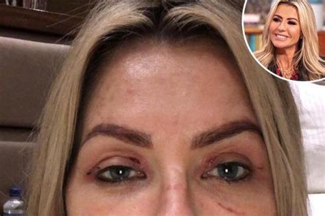Real Housewives Of Cheshire Star Dawn Ward Reveals She Bought Herself Eye Lift Surgery For