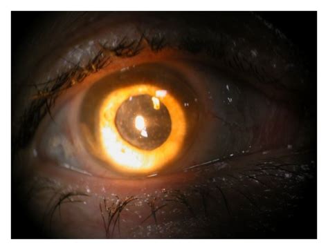 Pseudophakia Secondary Cataract And Anterior Granulomatous Uveitis In