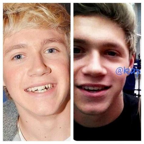 Lucy 8 Dayss On Twitter Niall Before And After Braces Hes Still