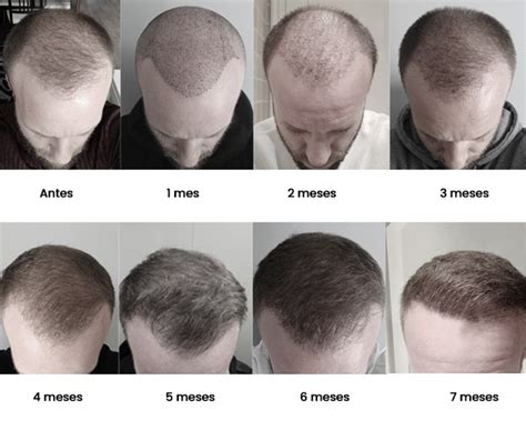 Top 107 6 Weeks After Hair Transplant Polarrunningexpeditions
