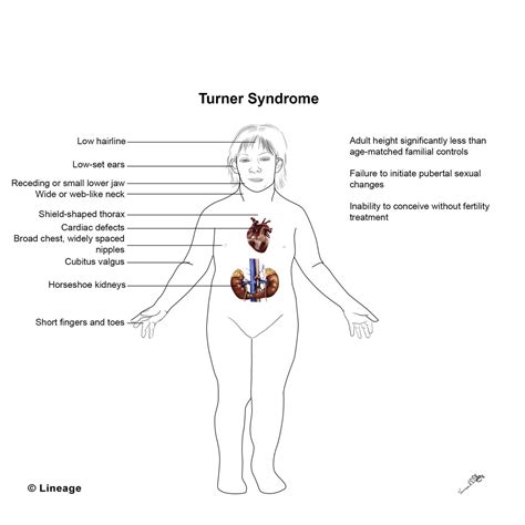 Turner Syndrome Reproductive Medbullets Step 1