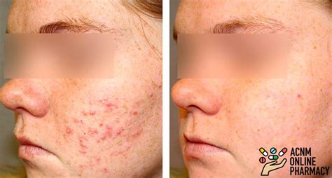 Accutane Acne Treatment Drug Reviews Pics Before And After Cost And