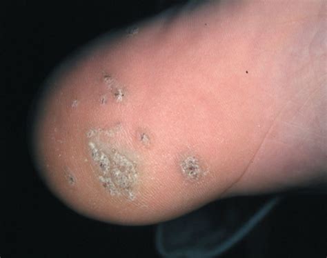 Strash Foot And Ankle Care Warts