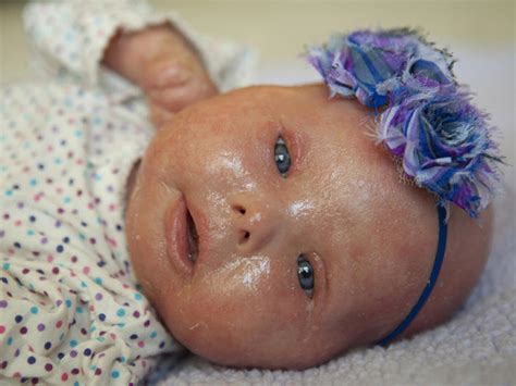 Meet Brenna A Baby With Harlequin Ichthyosis Photo 3 Pictures