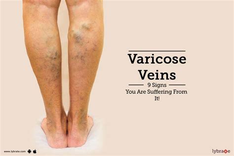 Varicose Veins 9 Signs You Are Suffering From It By Dr Himanshu Verma Lybrate