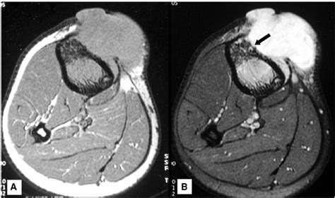 Mri Axial T1 Weighted Pre Contrast A And Post Contrast B Images