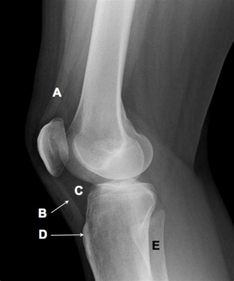 Lateral Radiograph Of The Knee The Bmj
