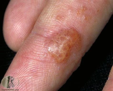 small fluid filled bumps on hands things you didn t know