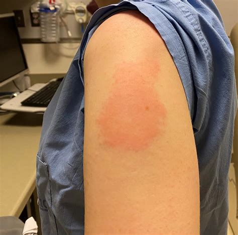 Moderna Arm Rash Virginia Mans Skin Peeled Off After Jandj Covid
