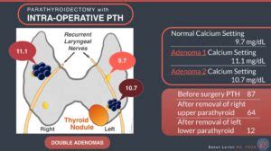 Parathyroidectomy With Intra Operative PTH Double Adenomas