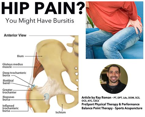 Experiencing Hip Pain You May Have Bursitis