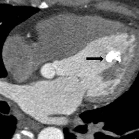 Pdf Calcified Amorphous Tumors Ct And Mri Findings