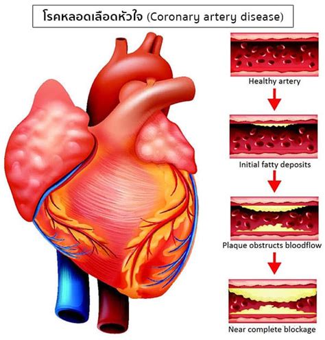 โรคหลอดเลือดหัวใจ Coronary Artery Disease อาการ สาเหตุ การรักษา ฯลฯ