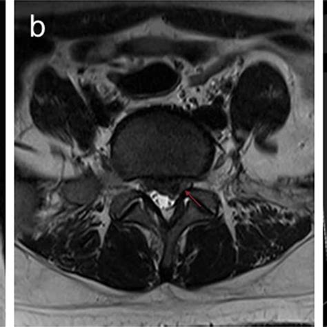 Preoperative Lumbar Disc MRI And Lumbosacral Nerve Root DTI Scan A Download Scientific