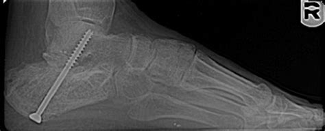 An Intraosseous Lipoma Of The Calcaneus A Case Report The Journal Of