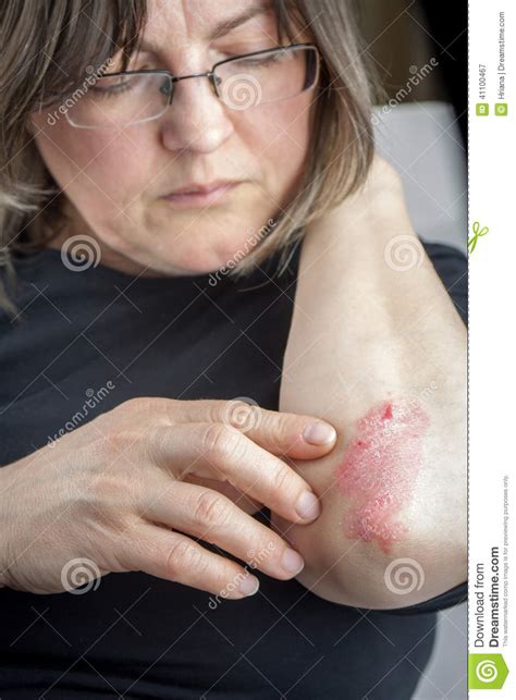 Psoriasis On Elbow Stock Image Image Of Plaque Caucasian 41100467